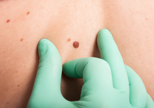 A picture of a doctor checking a patient's mole for skin cancer