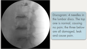 Discrogram image with text beside showcasing results | London Spine Clinic