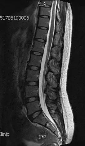 spinal_mri