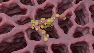 Small cancer tumors on the lung tissue: lung cancer (LC) – isometric view 3d illustration