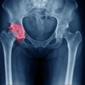An X-ray of a patients hip