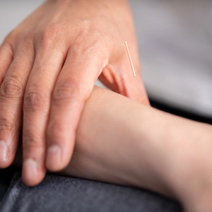 Acupuncture needle in arm