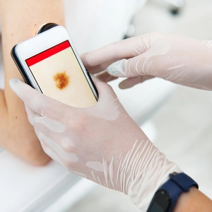 An image of a doctor taking a photo of a mole for analysis