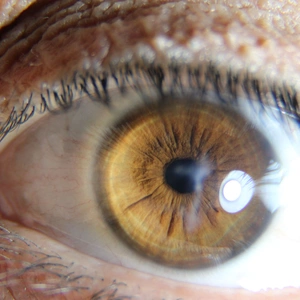 Close up of male brown eye with keratoconus