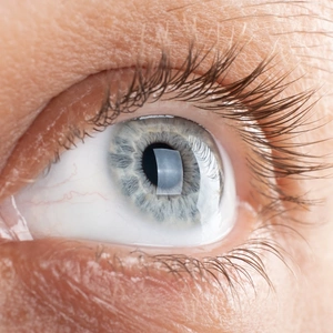 Close up of woman's eye with corneal dystrophy, keratoconus, thinning of the cornea.